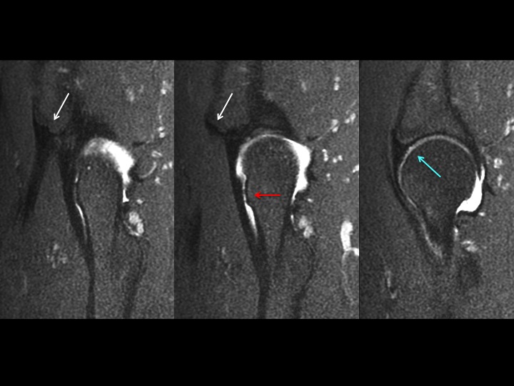Figure 4 for case subspine impingement